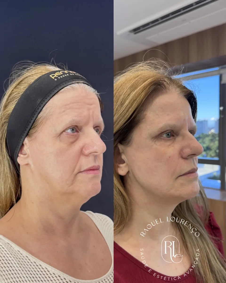 Antes e depois real de paciente — resultado do Protocolo NEW NATURE