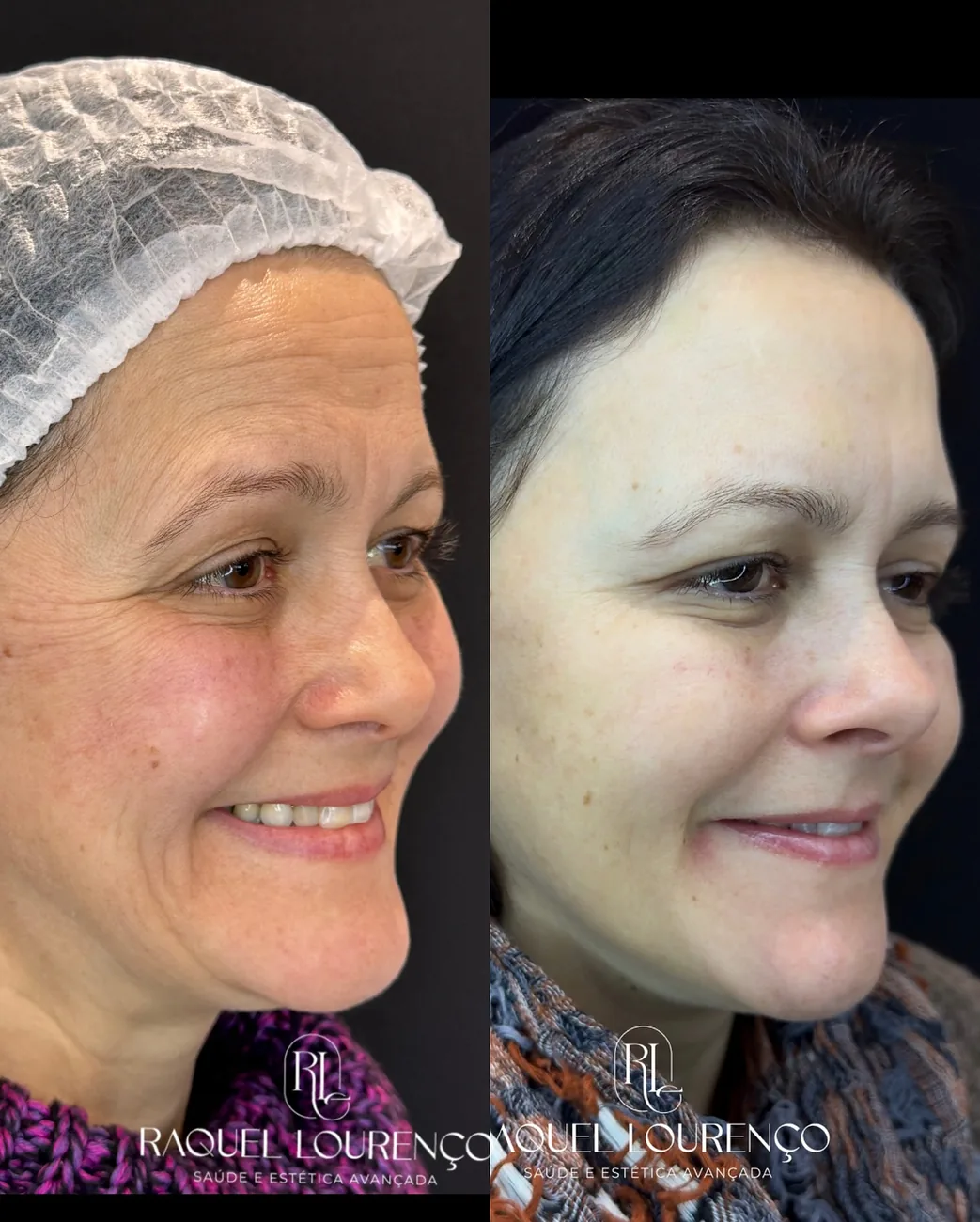 Antes e depois real de paciente — resultado do Protocolo NEW NATURE