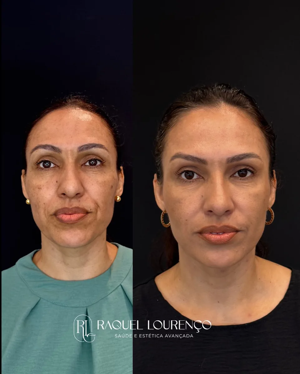 Antes e depois real de paciente — resultado do Protocolo NEW NATURE